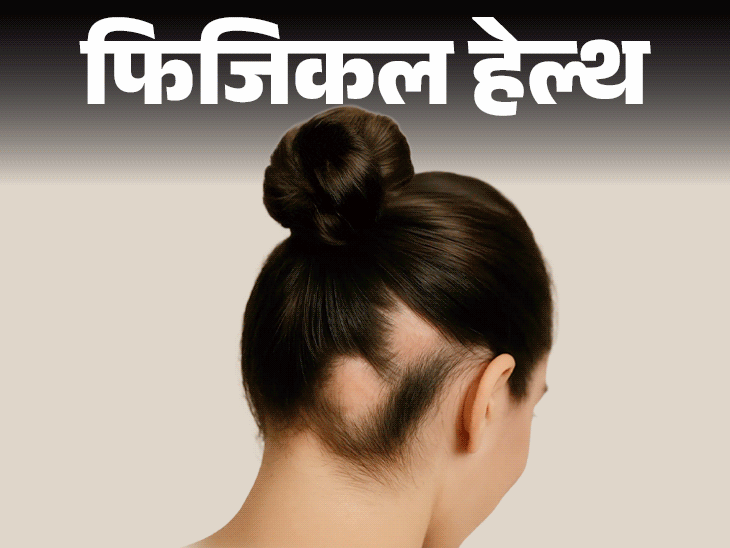 What is Alopecia Areata? Causes, Symptopms & Treatment; Autoimmune Disease, Bald Patches Reason