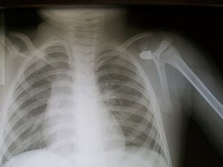 ग्वालियर में संदिग्ध हालात में महिला को लगी गोली:घर की सफाई करते समय कंधे में लगी गोली, सीटी स्कैन में पता लगा