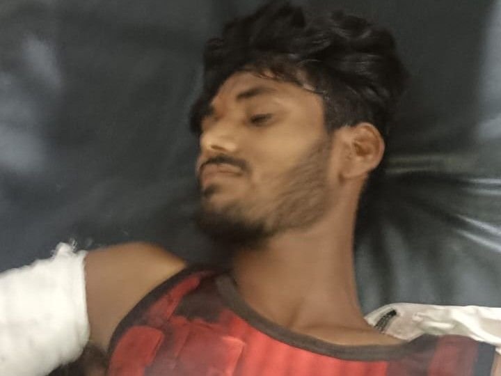 सीधी में बस-पिकअप में टक्कर, युवक का हाथ कटकर अलग:रीवा रेफर; चश्मदीद बोले- बस ड्राइवर नशे में था, वाहन छोड़कर भागा