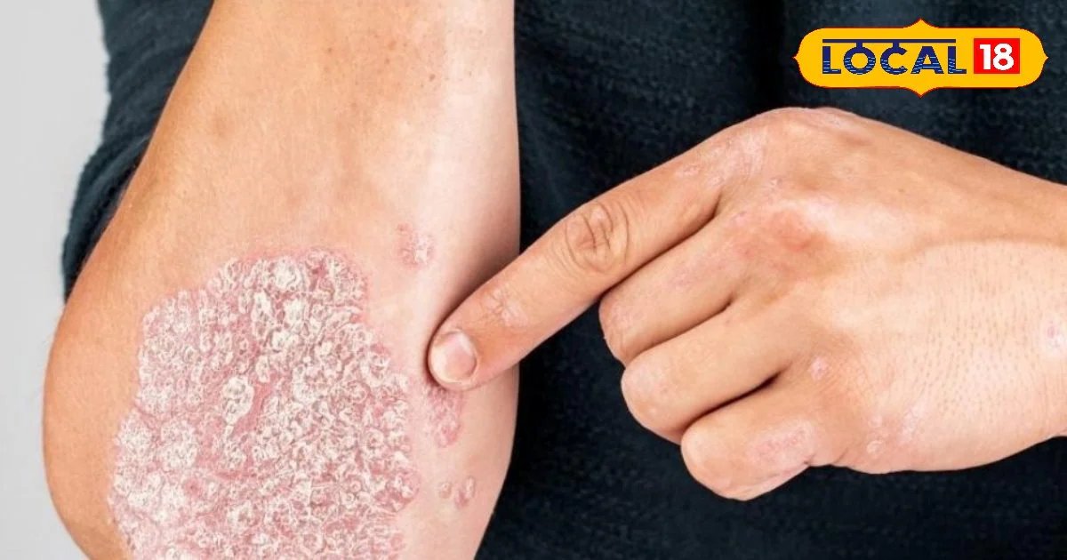 खुजली और लाल चकत्तों का ये है रामबाण इलाज, घर पर बनाएं आयुर्वेदिक क्रीम, समस्या होगी जड़ से खत्म, जानें आयुष डॉक्टर से