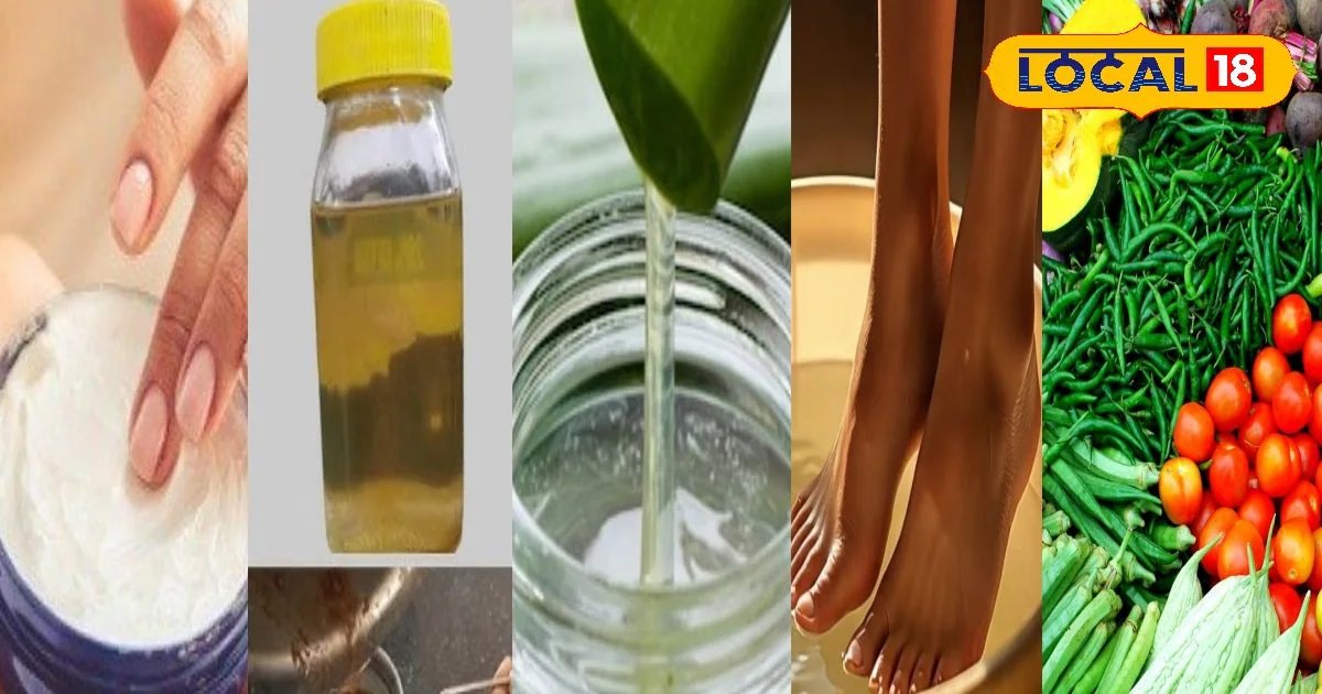 नाखून के किनारों की त्वचा क्यों निकलती है, जानें कारण और घरेलू उपायों से राहत पाने का आसान तरीका