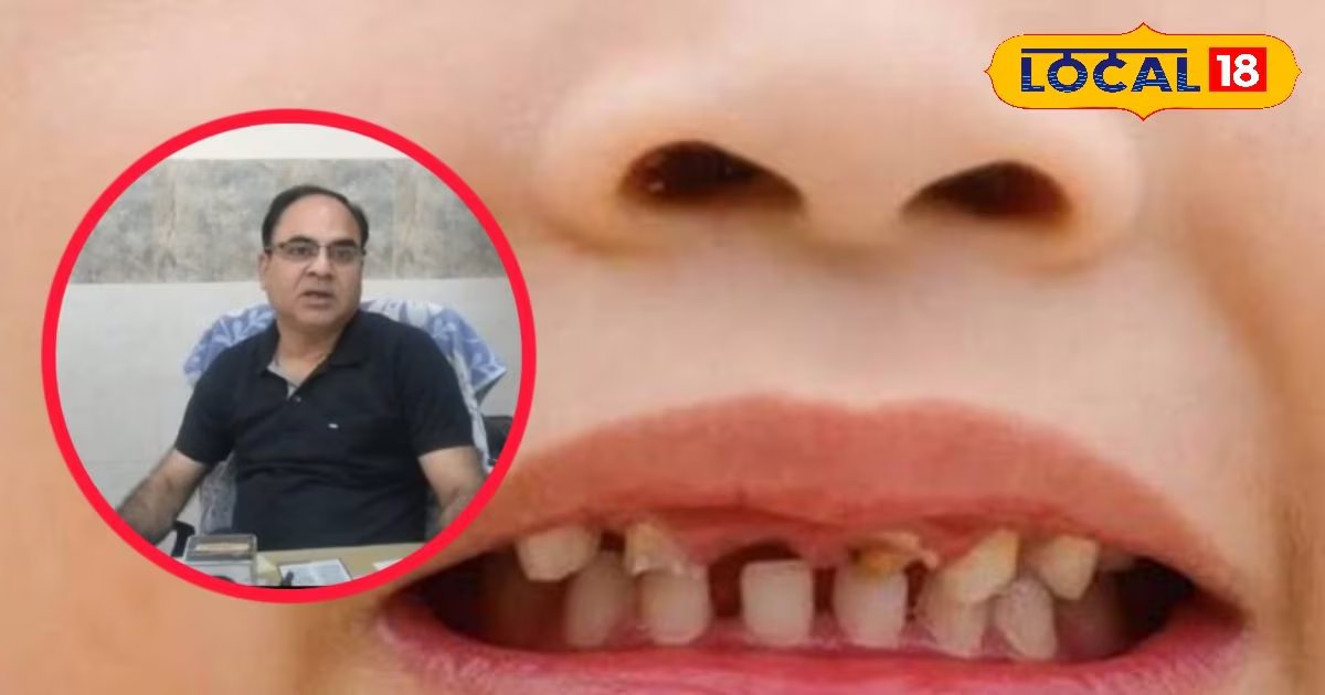 बच्चों में तेजी से बढ़ रही दांतों की सड़न, यहां डॉक्टर से जानिए कारण और बचाव के देसी तरीके
