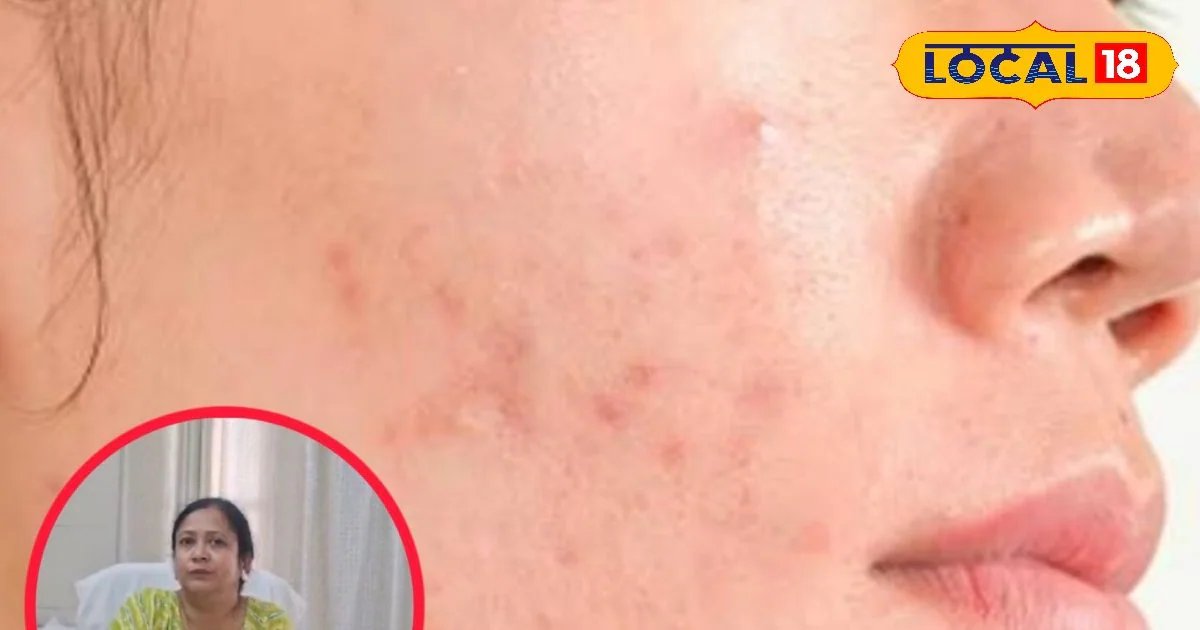 अगर तीखी धूप से आपकी स्किन भी हो रही खराब? बस अपना लें होम्योपैथिक डॉक्टर की ये खास सलाह