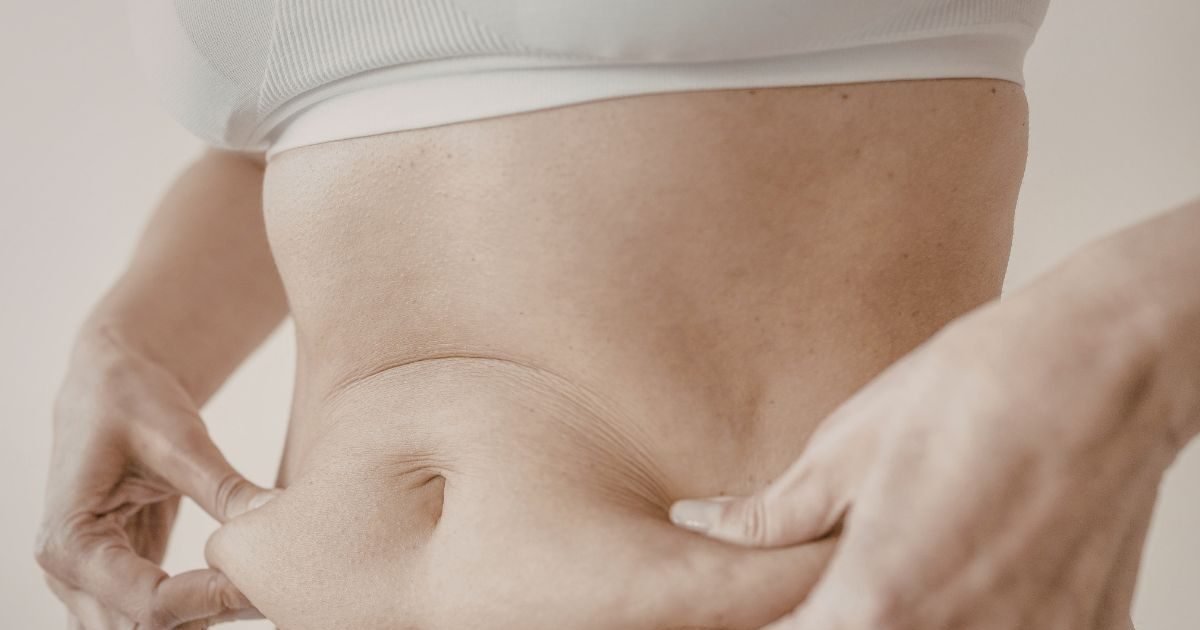 एक बार स्ट्रेच मार्क्स बन जाएं, तो क्या उन्हें हमेशा के लिए हटाया जा सकता है? डॉक्टर ने बताया सच