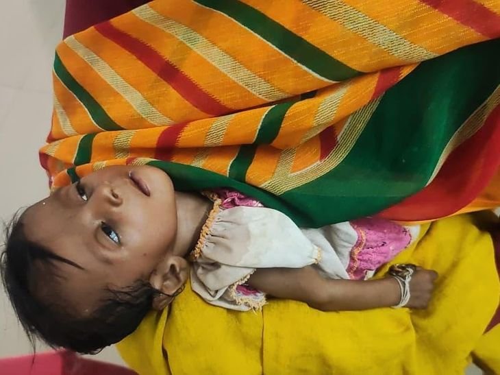 कुपोषण से बच्ची की मौत का मामला, आंगनबाड़ी कार्यकर्ता बर्खास्त:निगरानी में चूक पर दो सुपरवाइजर का इंक्रीमेंट दो साल तक रुका