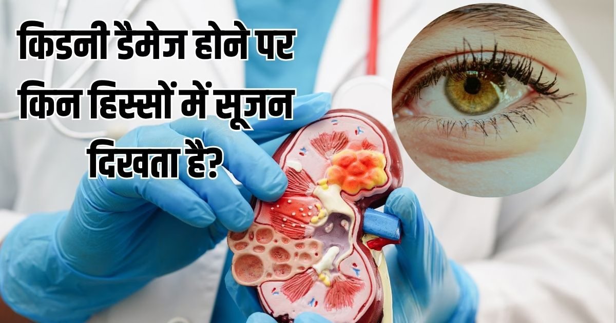 Kidney Damage Sign: चुपचाप सड़ रही किडनी, शरीर के इन 4 हिस्सों में सूजन रेड फ्लैग, आप तो नहीं कर रहे इग्नोर
