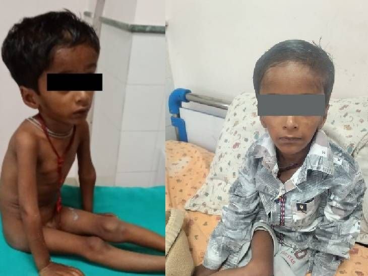 5 साल के बच्चे का वजन सिर्फ 5.5 किलो:SAM रोग से जूझ रहा था; भोपाल एम्स में लाइफ-सेविंग ट्रीटमेंट से मिली नई जिंदगी