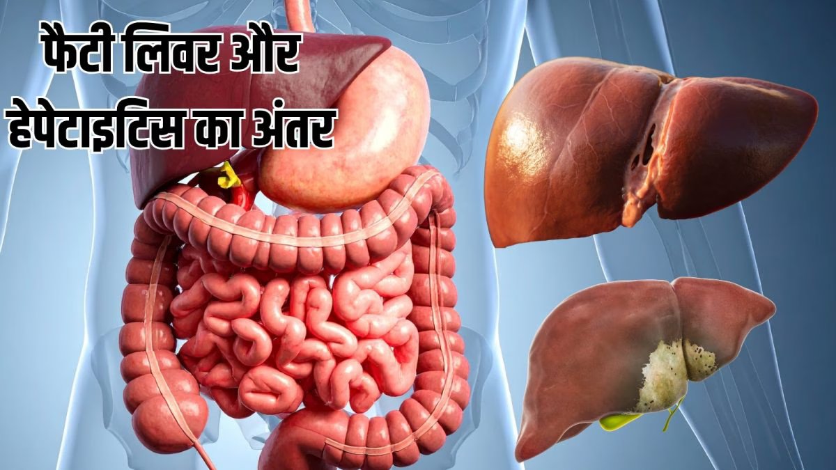 Liver Disease: लिवर की ये दो बीमारियां क्यों हैं अलग-अलग? एक्सपर्ट से जानें फैटी लिवर और हेपेटाइटिस का अंतर