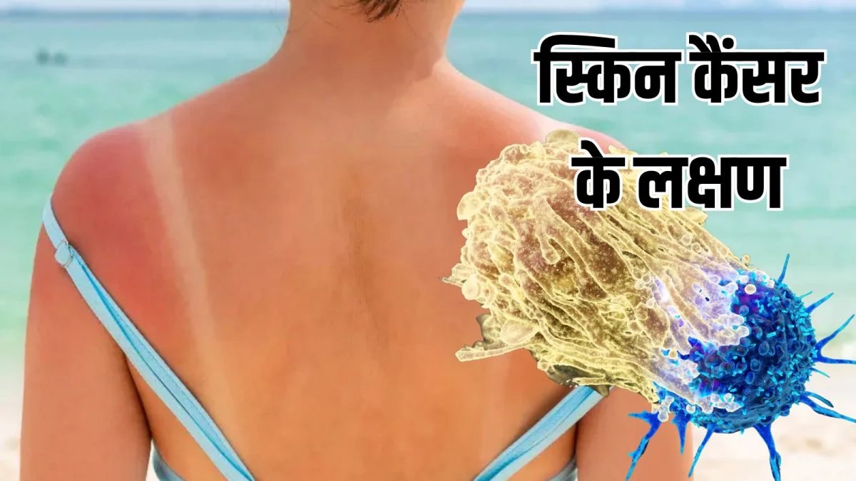 बार-बार हो रही टैनिंग? डॉ. की चेतावनी हो सकता है स्किन कैंसर का शुरुआती लक्षण