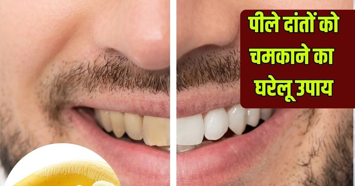 Yellow Teeth Remedies: मोती समान चमक उठेंगे पीले-सड़ते दांत, केले के छिलके से करें ये आसान उपाय